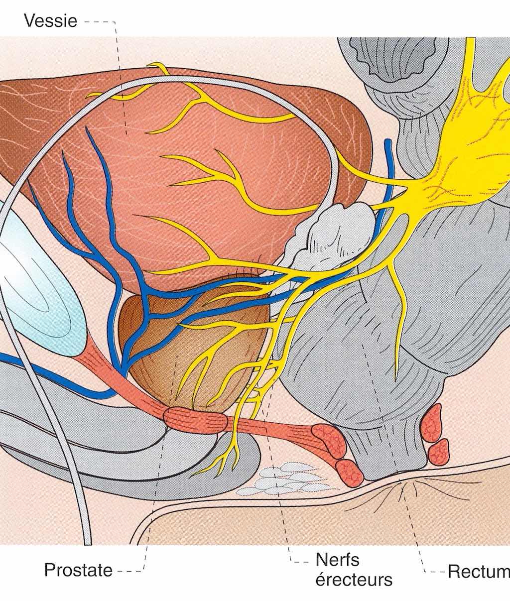 Les nerfs de l'érection sont situés à l'extérieur de la prostate
