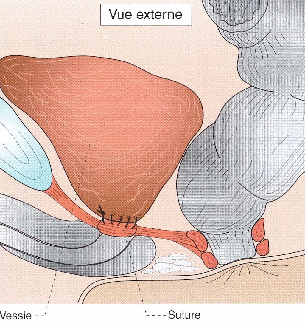les vésicules séminales ont été retirées