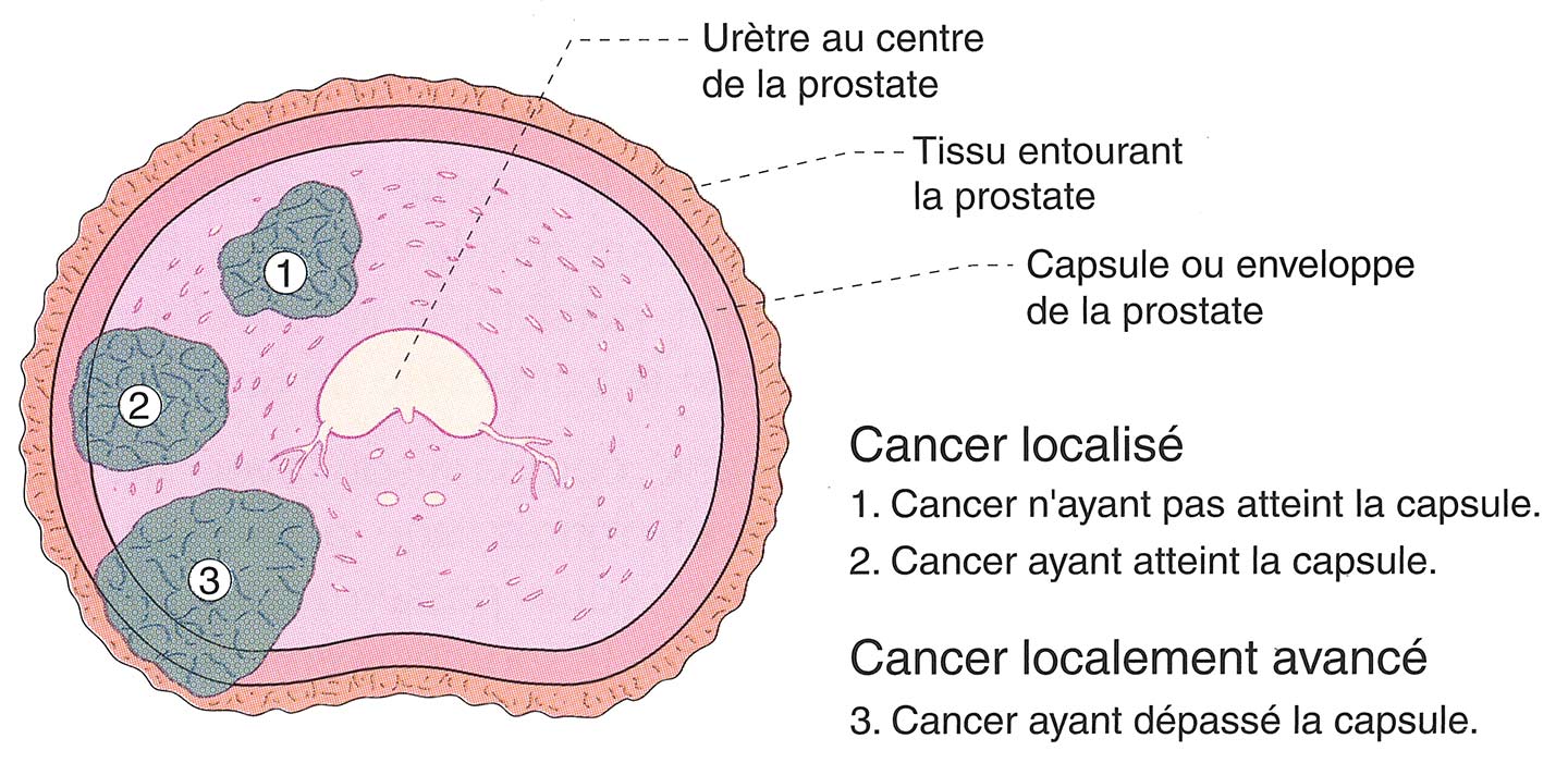 Le cancer a dépassé la capsule. Stade localement avancé T3 ou pT3