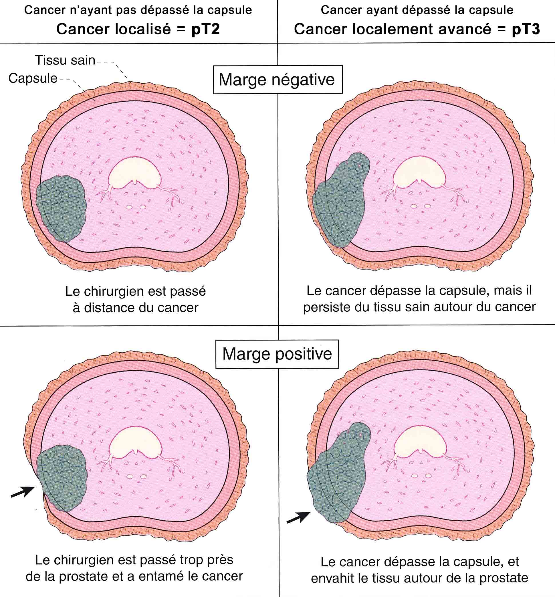 Cancer Colon Stadiul three - Cancer colorectal esperance de vie