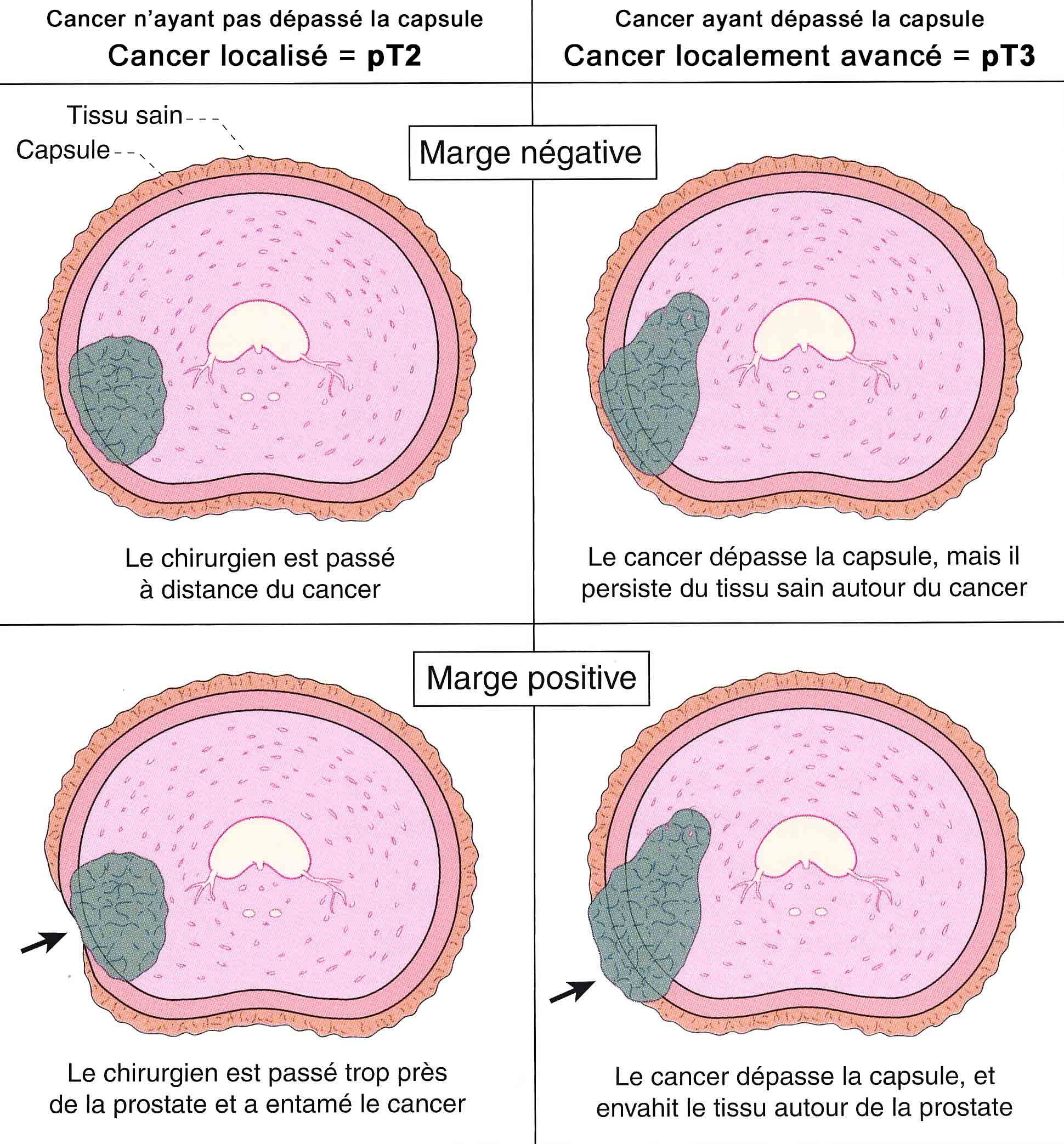 Le cancer a dépassé la capsule. Stade localement avancé T3 ou pT3