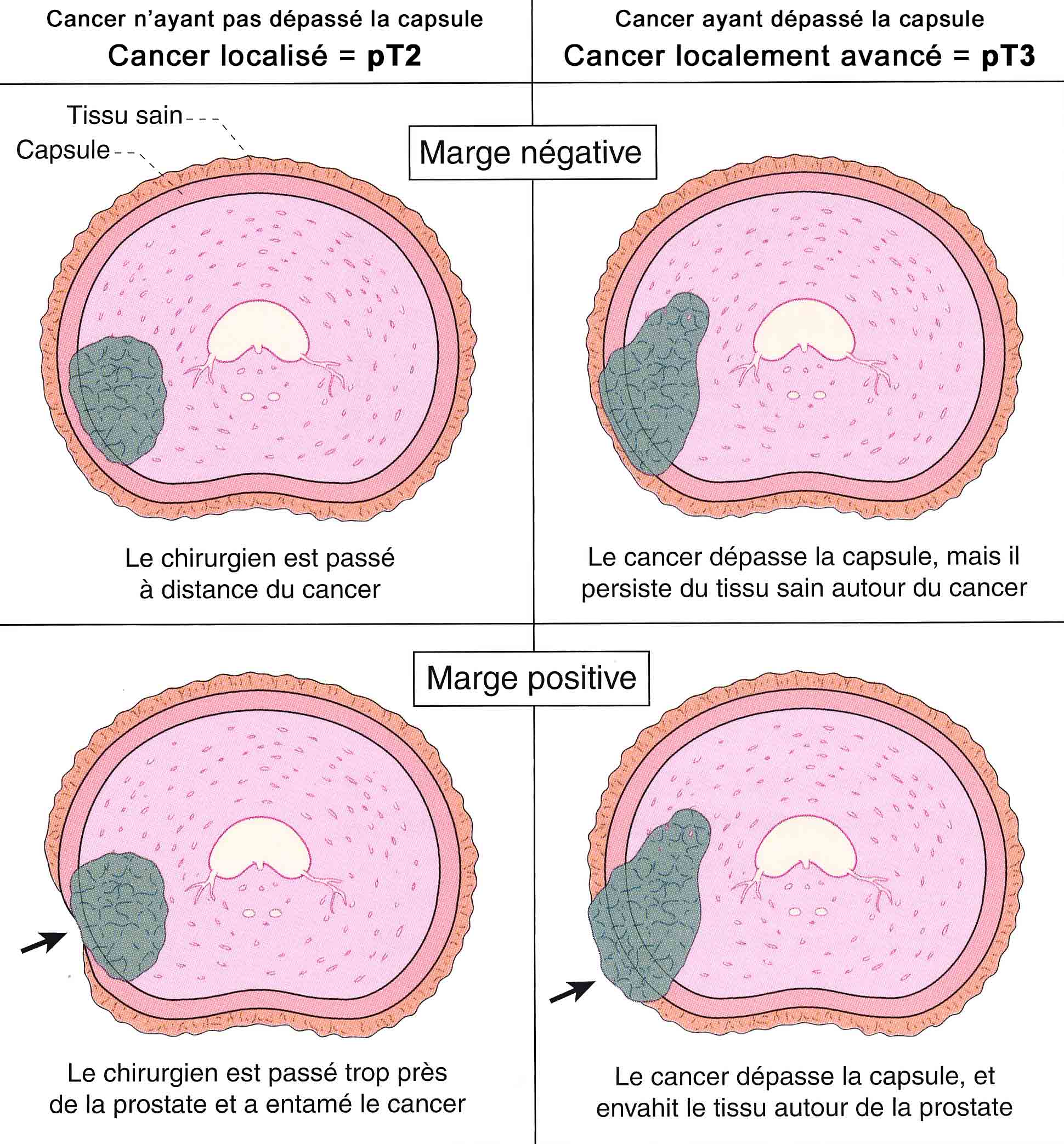 cancer prostate survie sans traitement